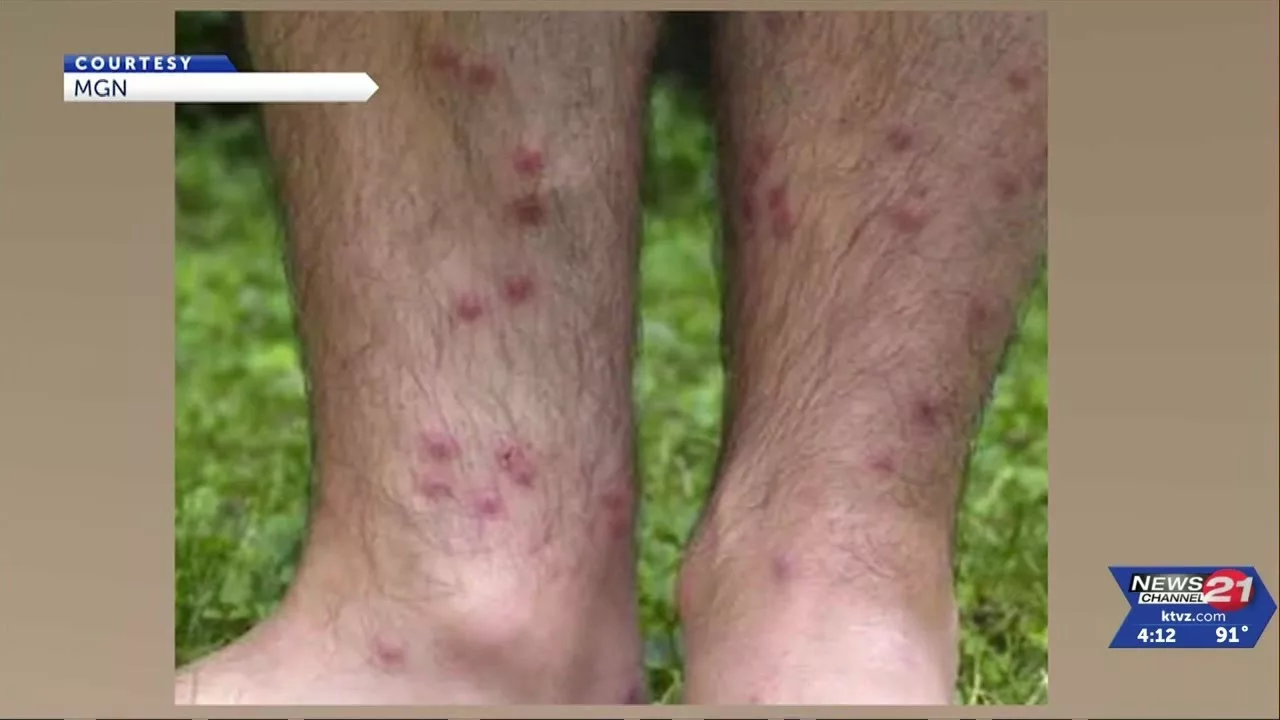 Allergic Reaction Caused by Parasites Draws Renewed Attention to a Rash Called “Swimmer’s Itch” | KTVZ NewsChannel 21