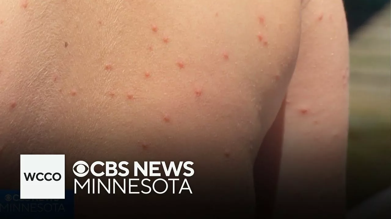 What Causes Swimmer’s Itch? | WCCO – CBS Minnesota